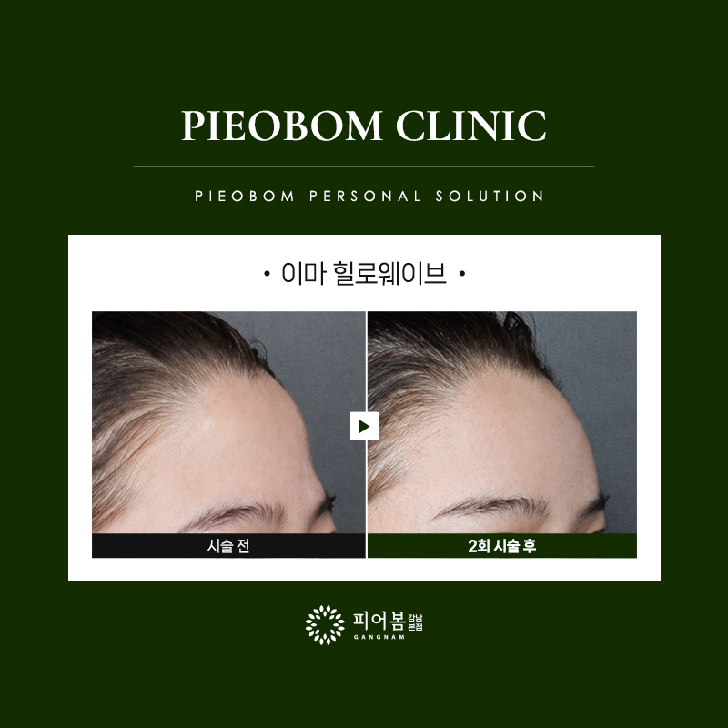 강남역힐로웨이브 힐로웨이브후기 이마힐로웨이브 힐로웨이브이마│강남역피부과 피어봄의원 강남본점 전후사진