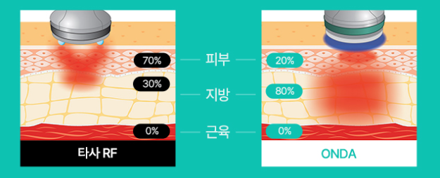 강남역온다리프팅 극초단파 원리