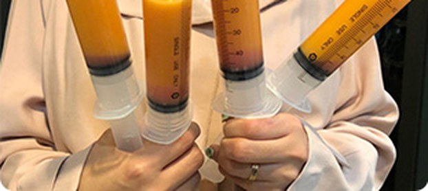 에스팻 지방추출 주사로 추출한 지방이 담긴 주사기 3